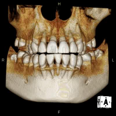 歯周病のCT画像