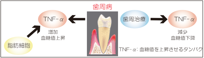 歯周病と糖尿病